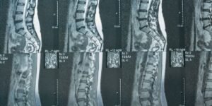 Two-Thirds of Back MRI Requests Missed the Guidelines in a New Audit. What That Means for Back Pain Spending in West Orange