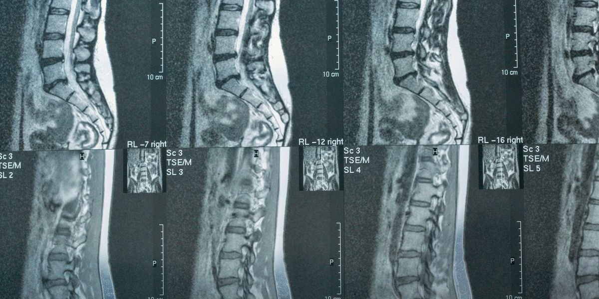 Two-Thirds of Back MRI Requests Missed the Guidelines in a New Audit. What That Means for Back Pain Spending in West Orange